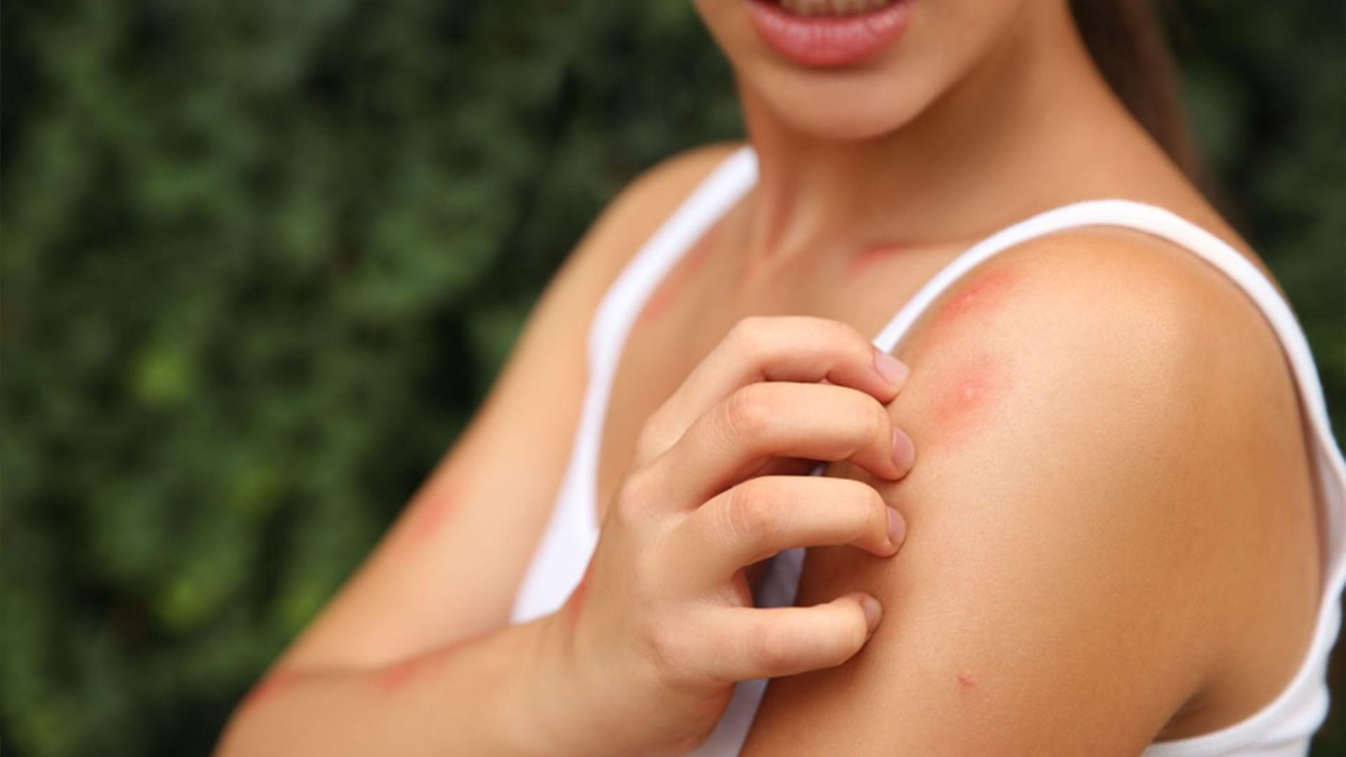 6 Home Remedies For Itchy Mosquito Bites